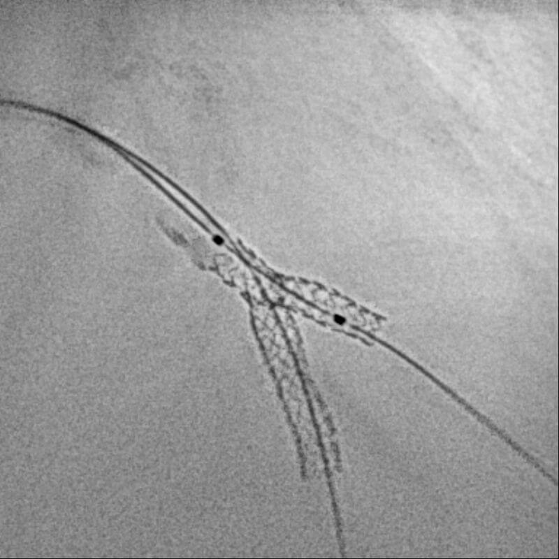 Bifurkations-PCI