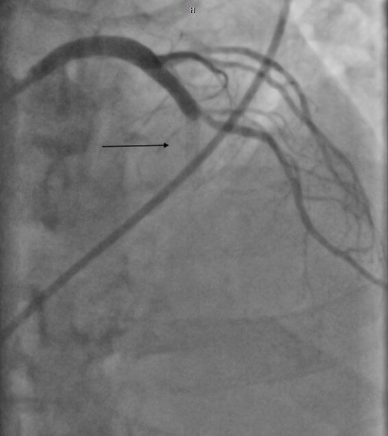 In-Stent Stenose Ostiale Stenose